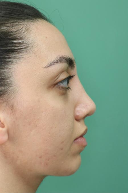 After image 4 Case #126796 - Nasal Deviation Syndrome. Rhinogenic Headache 