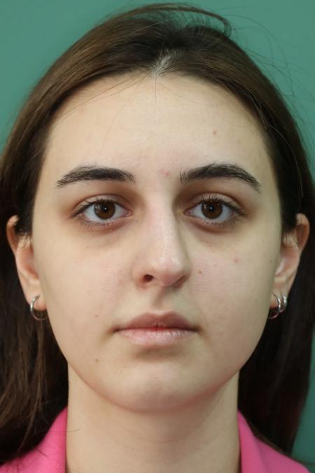 Before image 1 Case #122886 - Functional Aesthetic Septorhinoplasty