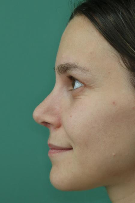 After image 4 Case #122911 - Primary Septorhinoplasty