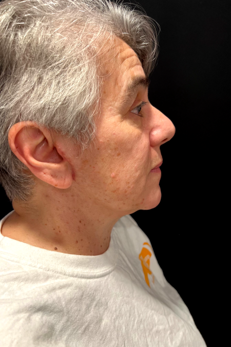 After image 3 Case #127521 - Neck Lift