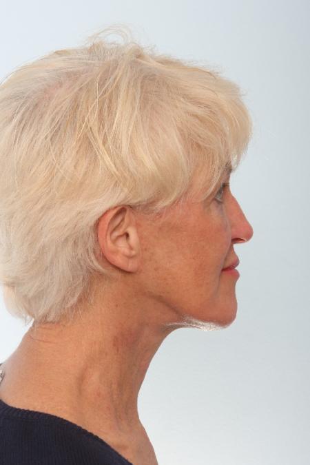After image 3 Case #127061 - Facelift