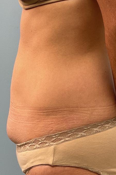 Before image 3 Case #126926 - a 47 year old female; mini tummy tuck w/ lipo 360 