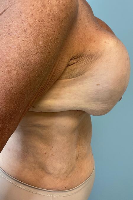 Before image 3 Case #127161 - 60 year old Breast Implant revision w/ tummy tuck