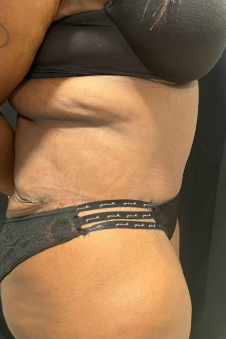 After image 3 Case #127501 - Abdominoplasty