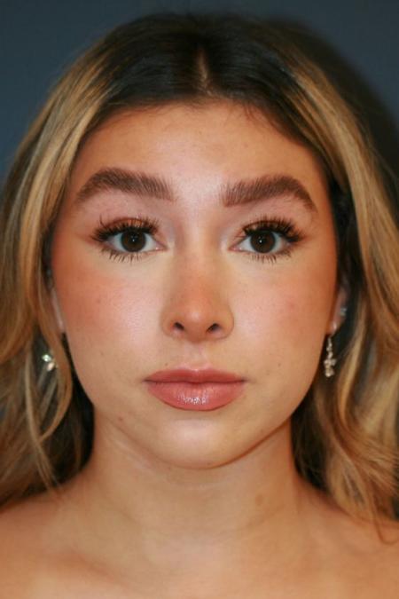 After image 1 Case #126961 - Female Rhinoplasty