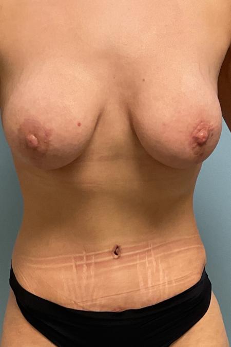 After image 1 Case #126956 - 38 year old female Breast Aug w/ abdominoplasty