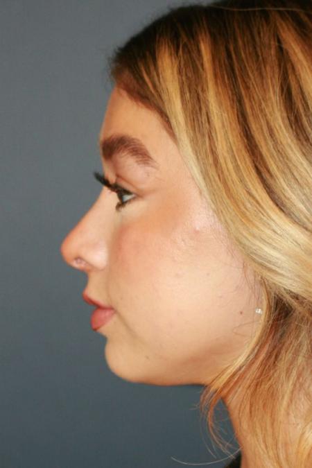 After image 3 Case #126961 - Female Rhinoplasty