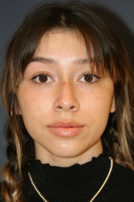 Before image 1 Case #126961 - Female Rhinoplasty