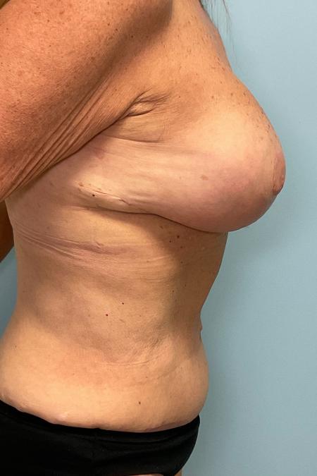 After image 3 Case #127161 - 60 year old Breast Implant revision w/ tummy tuck