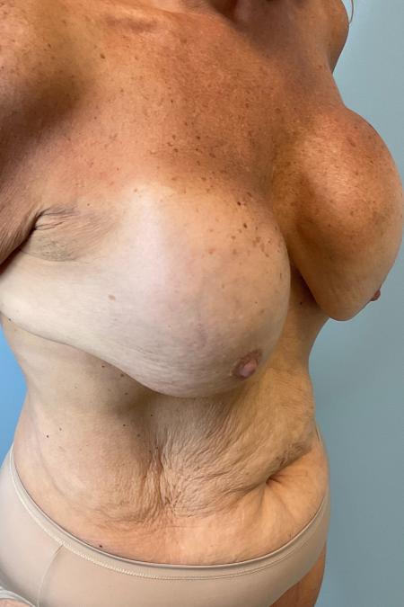 Before image 2 Case #127161 - 60 year old Breast Implant revision w/ tummy tuck