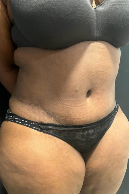 After image 2 Case #127501 - Abdominoplasty