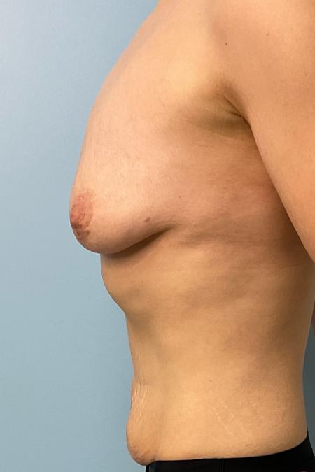 Before image 2 Case #126956 - 38 year old female Breast Lift with Abdominoplasty