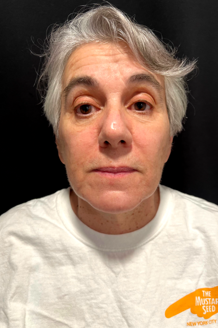 After image 1 Case #127521 - Neck Lift