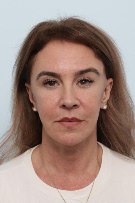 After image 1 Case #127056 - Facelift