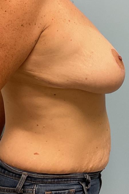 After image 2 Case #126986 - 44 year old female Breast Reduction w/ Lipo