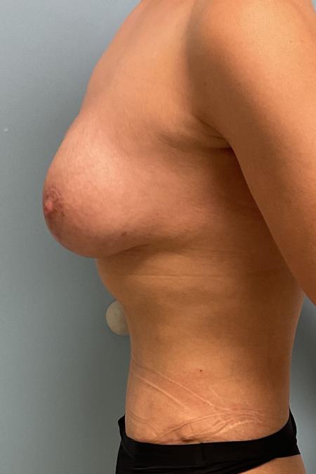 After image 2 Case #126956 - 38 year old female Breast Aug w/ abdominoplasty