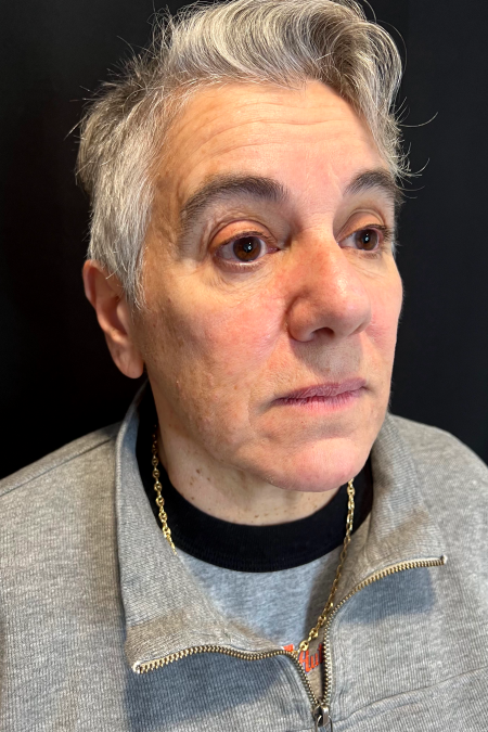 Before image 2 Case #127521 - Neck Lift