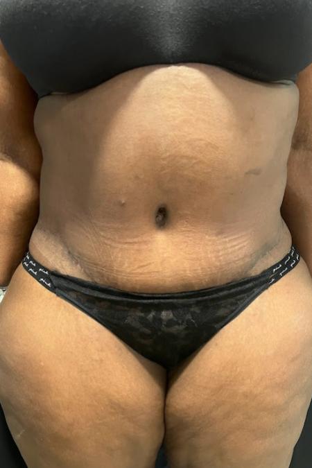 After image 1 Case #127501 - Abdominoplasty