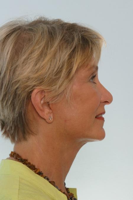 After image 3 Case #127156 - Facelift