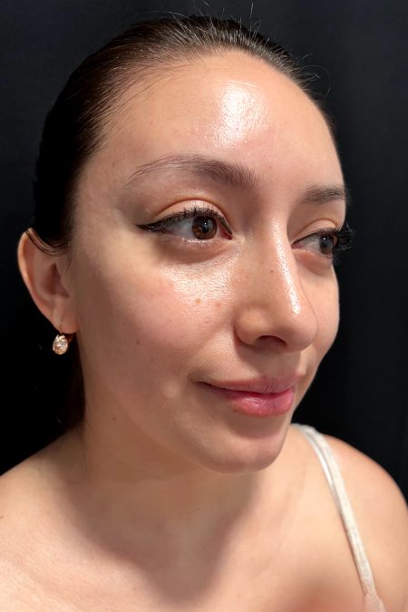 After image 2 Case #127526 - Septoplasty