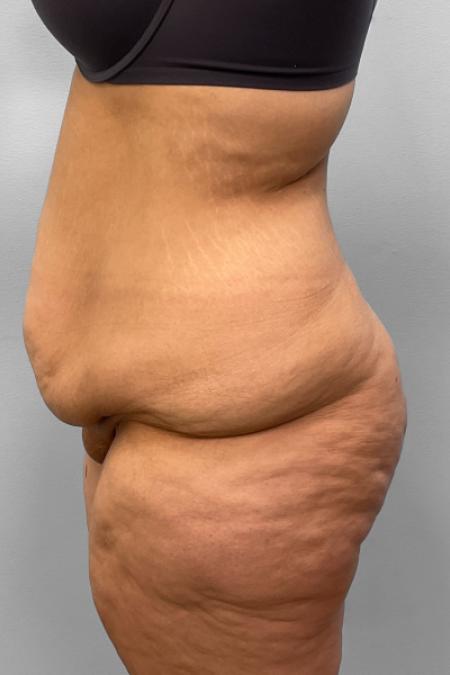 Before image 3 Case #127686 - Tummy Tuck