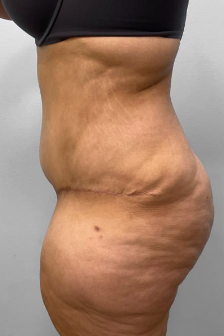After image 3 Case #127686 - Tummy Tuck