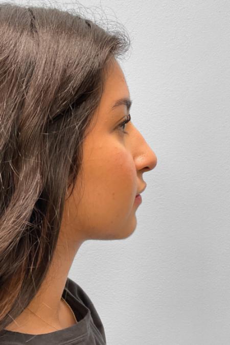 After image 3 Case #127656 - Rhinoplasty
