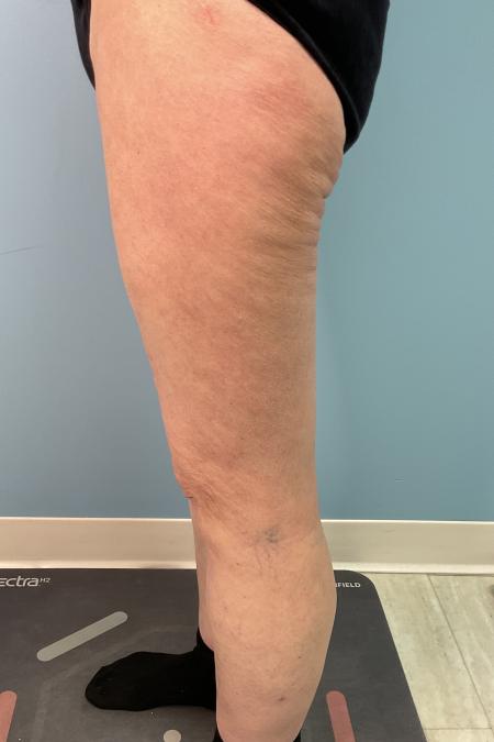 After image 3 Case #128241 - 66 y.o. female w/ Thigh Lift & Lipo Thighs & Calf