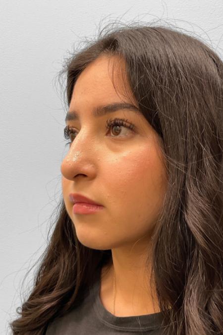 After image 2 Case #127656 - Rhinoplasty