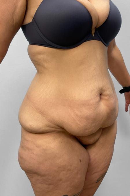 Before image 2 Case #127686 - Tummy Tuck