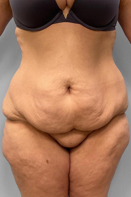 Before image 1 Case #127686 - Tummy Tuck