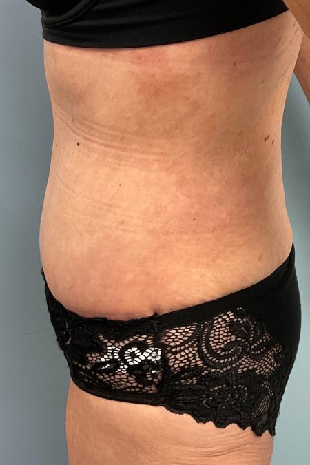 After image 3 Case #127556 - Tummy Tuck + Lipo of Flanks/Thighs + Bra Line Lift