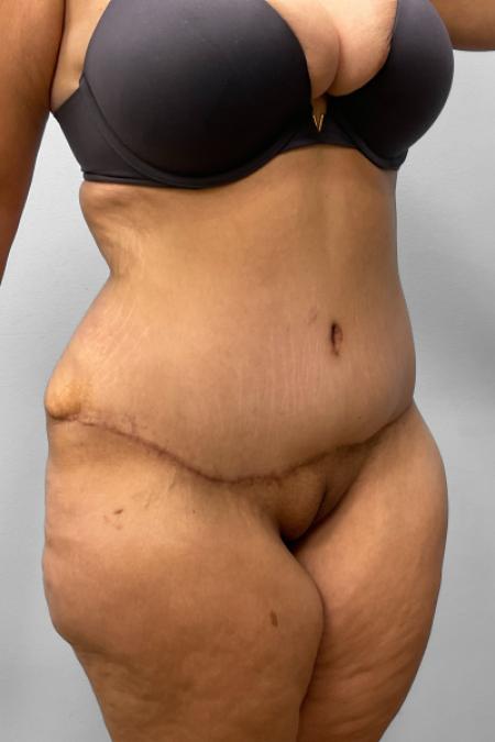 After image 2 Case #127686 - Tummy Tuck