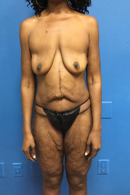 Before image 1 Case #128326 - Skin removal and breast implants after weight loss