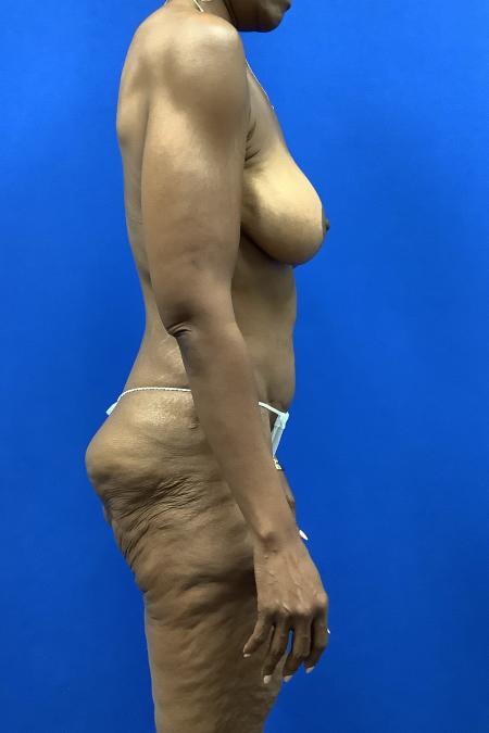 After image 3 Case #128326 - Skin removal and breast implants after weight loss