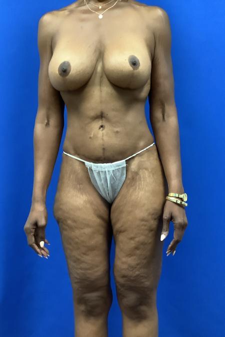 After image 1 Case #128326 - Skin removal and breast implants after weight loss