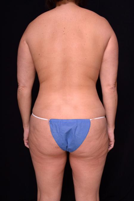 Before image 4 Case #128941 - Mommy Makeover - Augmentation Mastopexy