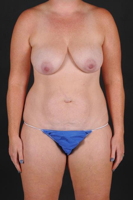 Before image 1 Case #128886 - Mommy Makeover - Mastopexy with Abdominoplasty