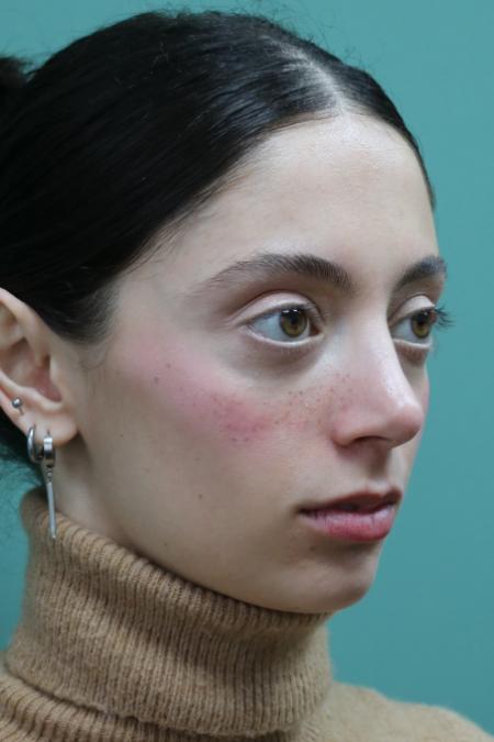 After image 3 Case #128876 - Primary Rhinoseptoplasty