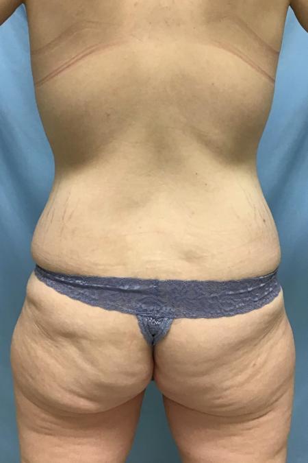 Before Case #129056 - 33 y.o. female w/ Tummy Tuck, Lipo and BBL