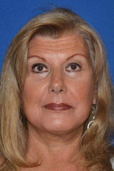 After image 1 Case #129046 - Face lift