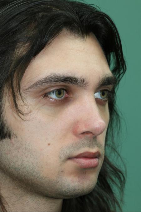 After image 2 Case #128871 - Primary Septorhinoplasty