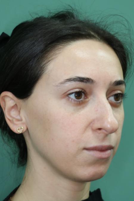 Before image 2 Case #128881 - Primary Rhinoseptoplasty