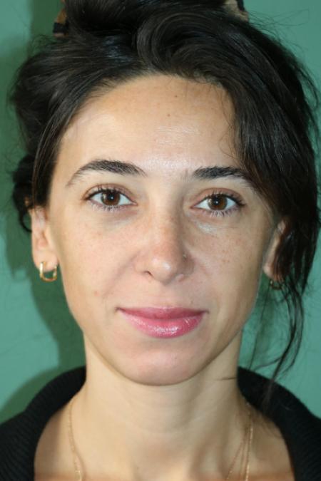 After image 1 Case #128881 - Primary Rhinoseptoplasty