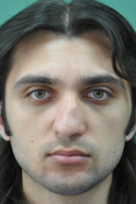 Before image 1 Case #128871 - Primary Septorhinoplasty