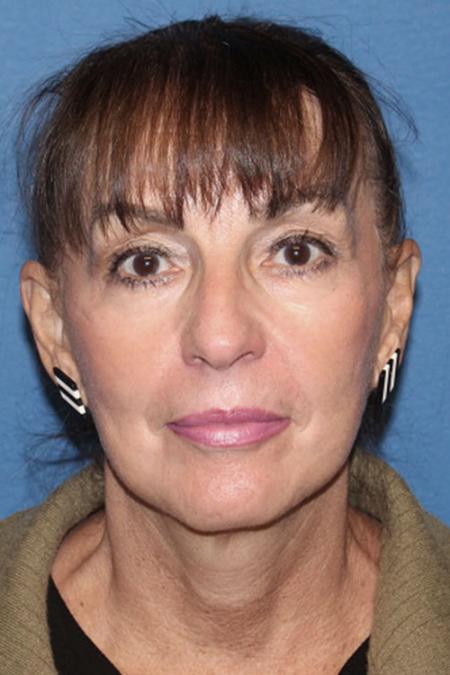 After image 1 Case #129041 - Facial Rejuvenation