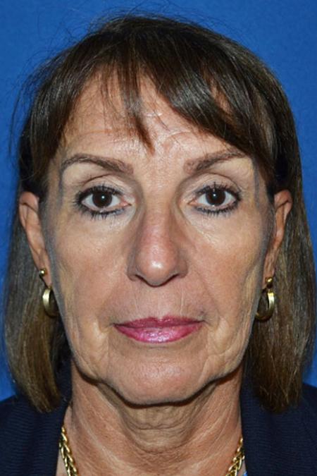 Before image 1 Case #129041 - Facial Rejuvenation