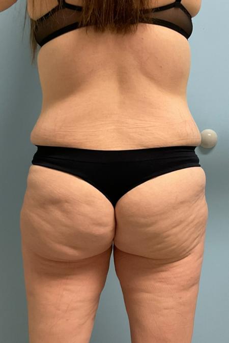 After Case #129056 - 33 y.o. female w/ Tummy Tuck, Lipo and BBL