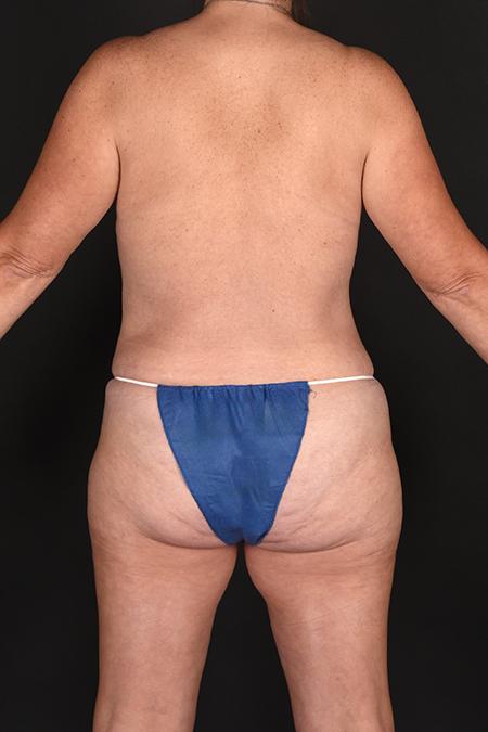 After image 4 Case #128961 - Mommy Makeover - Mastopexy and Abdominoplasty