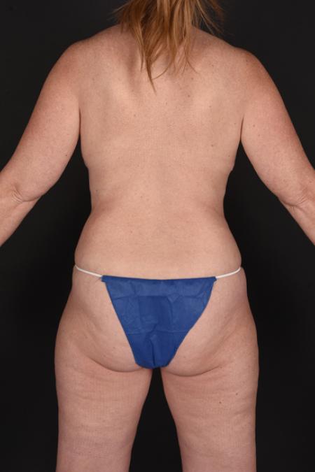 After image 4 Case #128866 - Mommy Makeover - Breast Implant Removal, Mastopexy